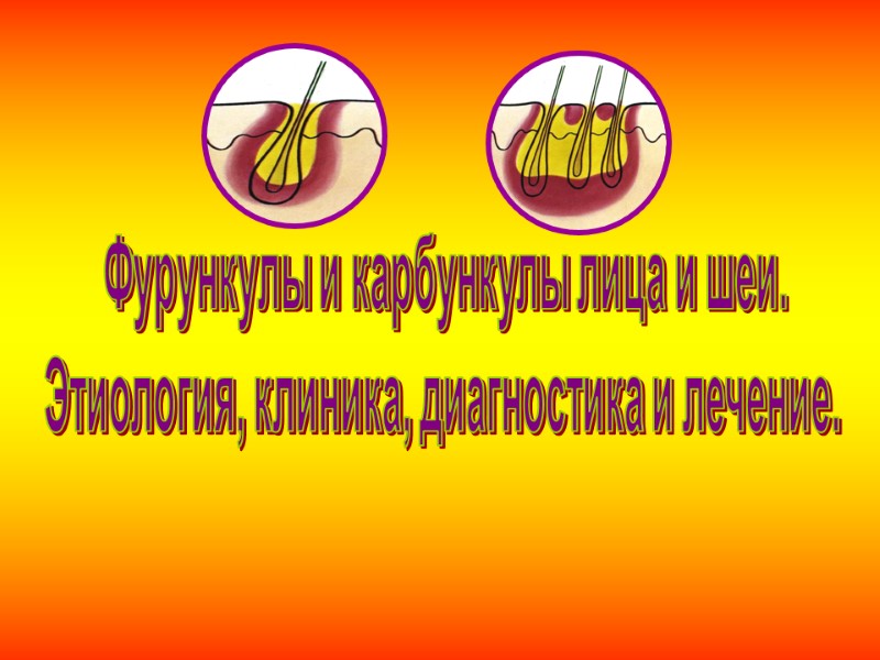 Фурункулы и карбункулы лица и шеи. Этиология, клиника, диагностика и лечение.